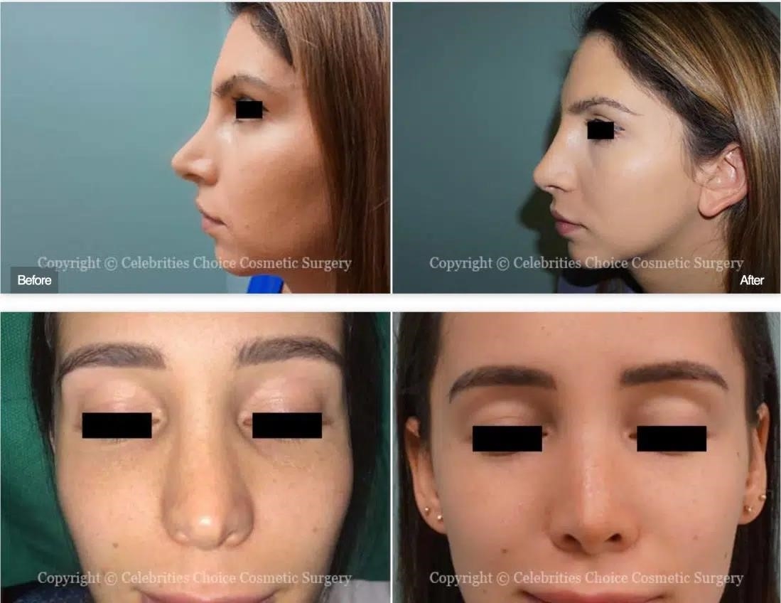 top rhinoplasty surgeons