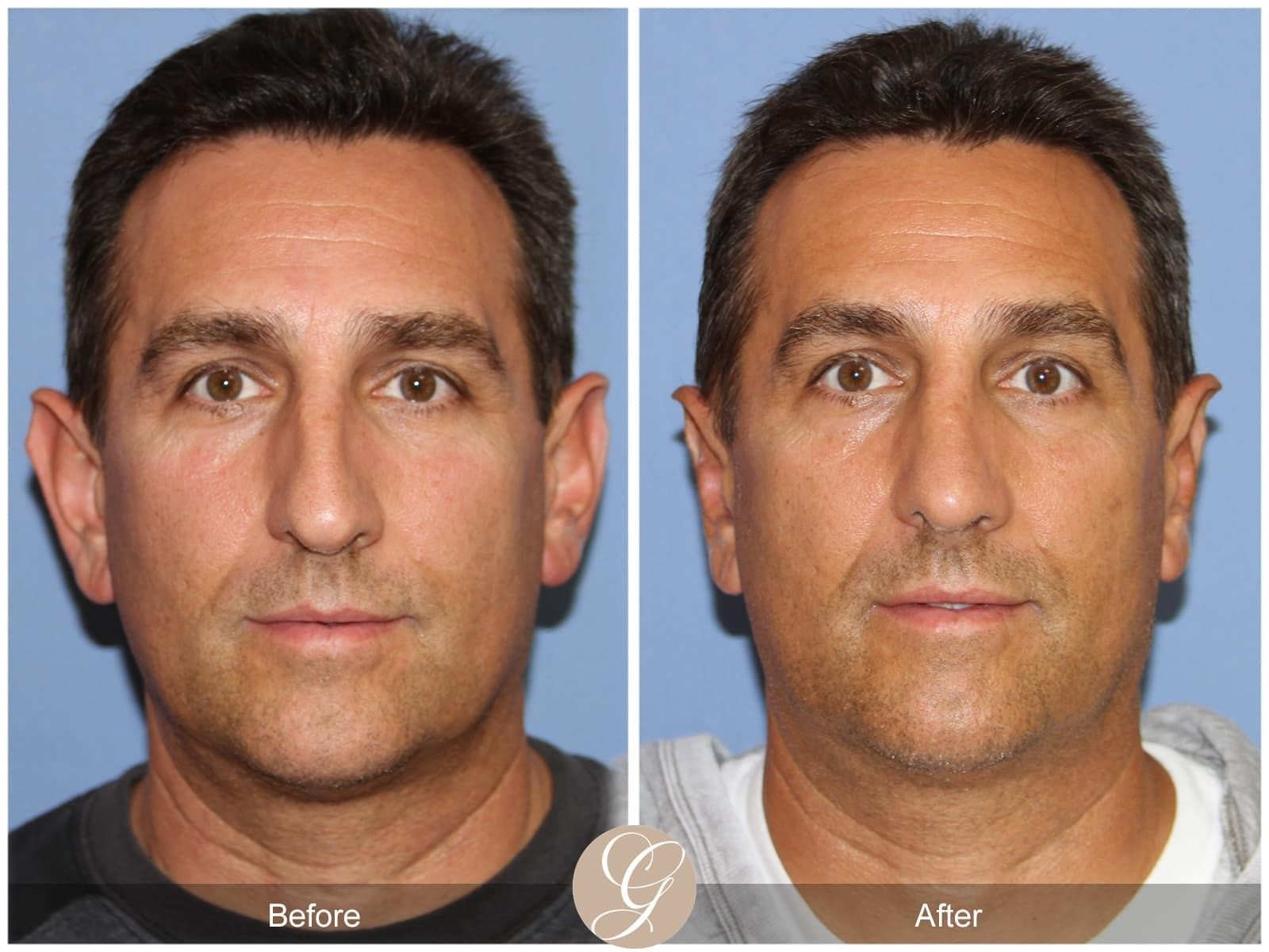 top rhinoplasty surgeons