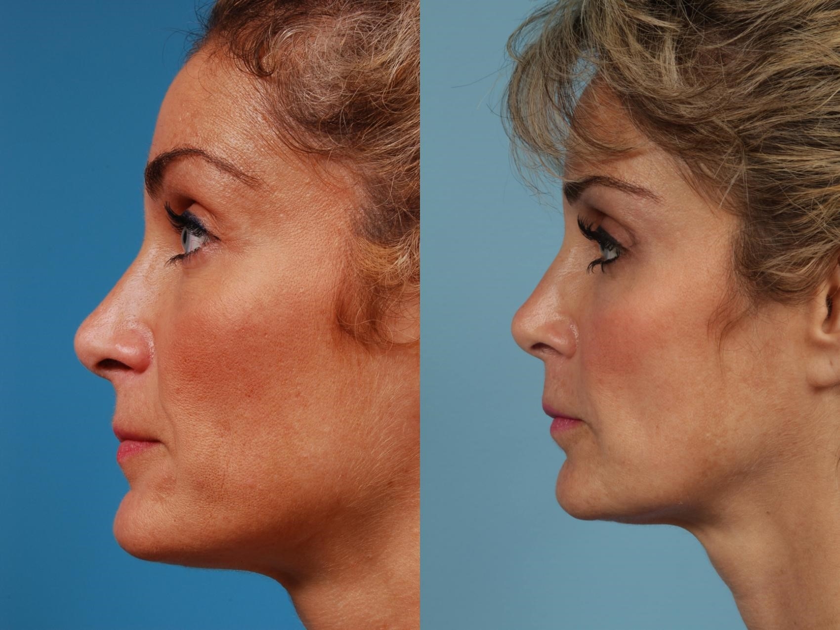 top rhinoplasty surgeons